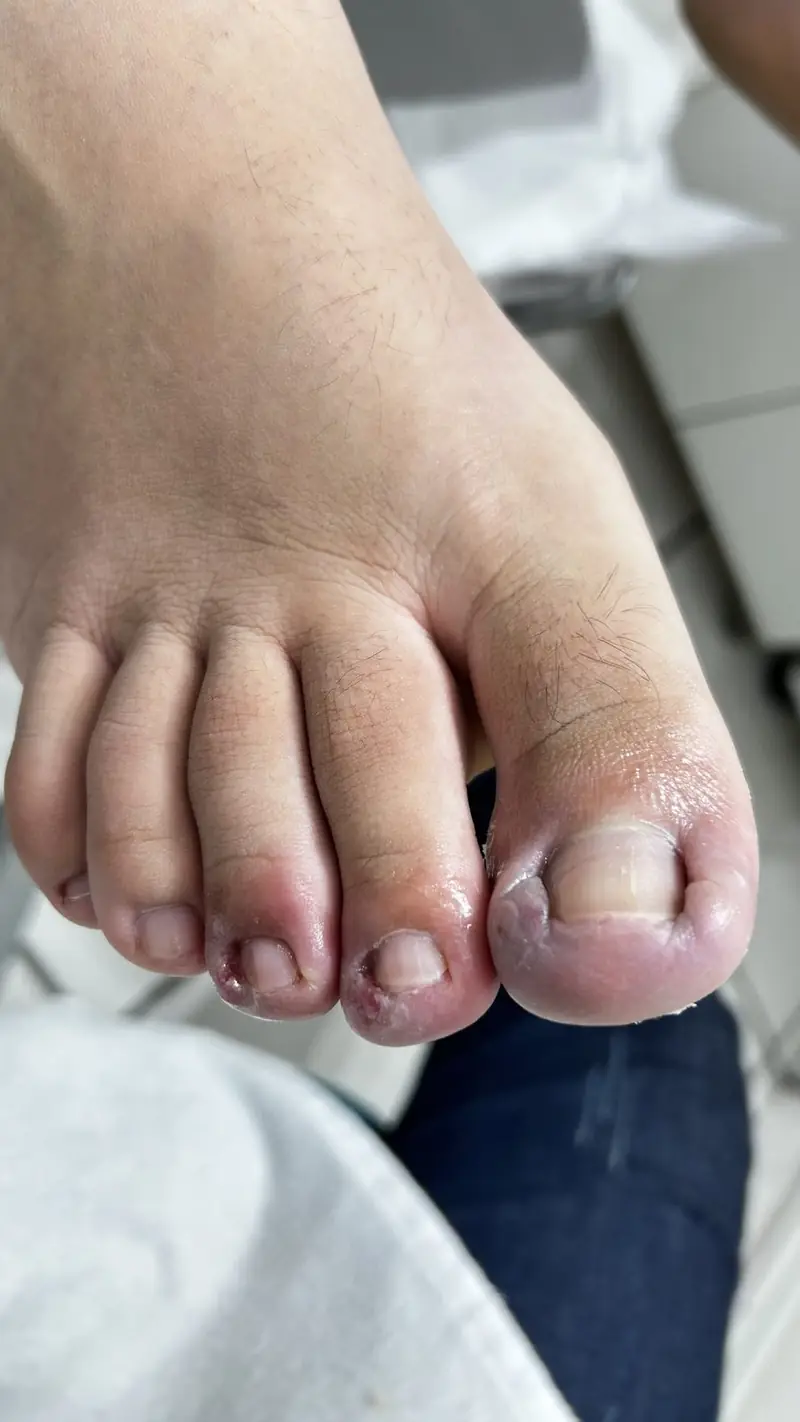 A mesma unha depois do procedimento, sem inflamação