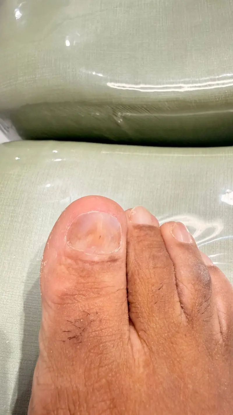 A mesma unha reconstruída com gel medicamentoso